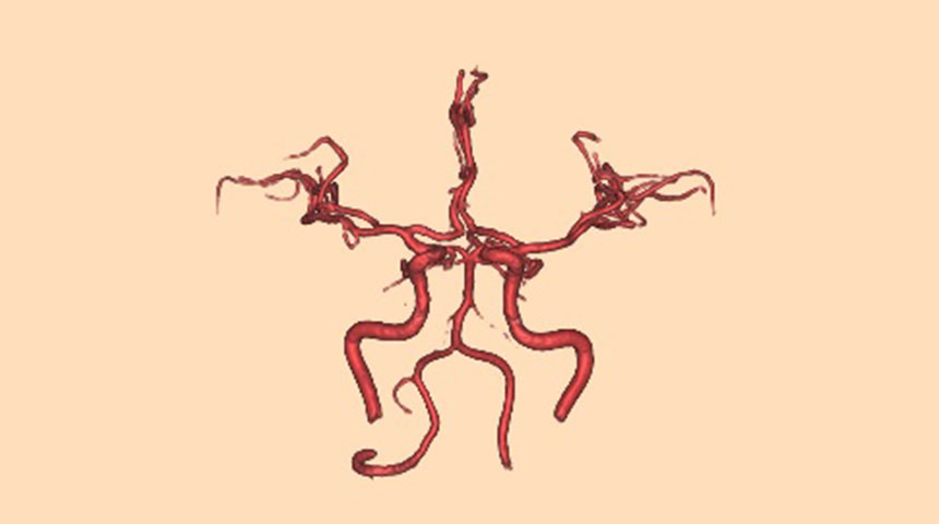 脳血管MRA